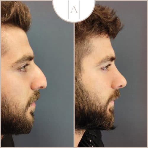 How safe is a rhinoplasty? - Asthetica